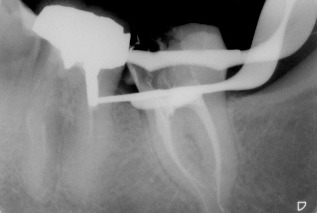 Endodonzia – “Devitalizzazioni”